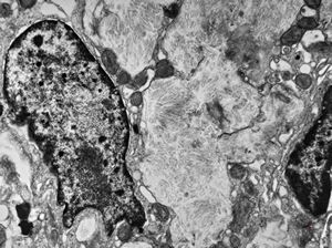F,58y. | Whipple disease F,58y. | Whipple disease